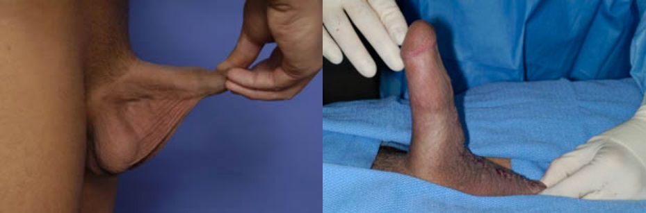 Chirurgia plastyczna pasów Penoscrotal (ang. Penoscrotal webbing plastic surgery)