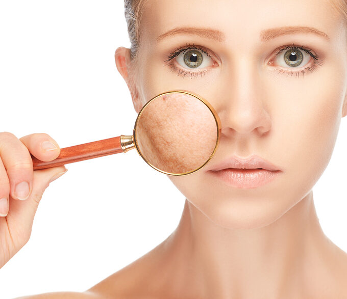 BioTrendy - Przebarwienia skóry – rodzaje oraz profilaktyka