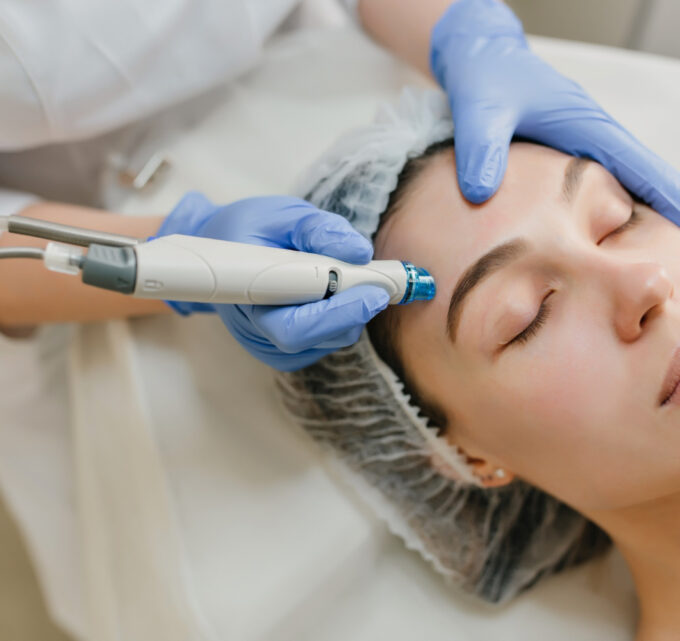 BioTrendy - Zalety zabiegu mezoterapii igłowej