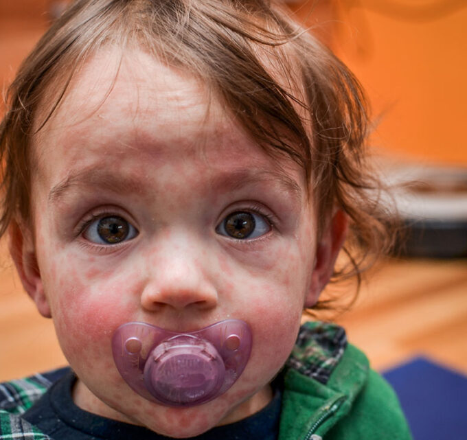 Biotrendy - Ile trwa bostonka i czy jest to groźna choroba