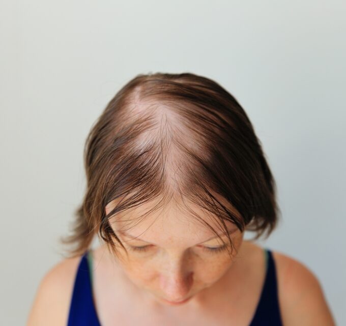 BioTrendy - Łysienie plackowate - jak sobie z nim poradzić?