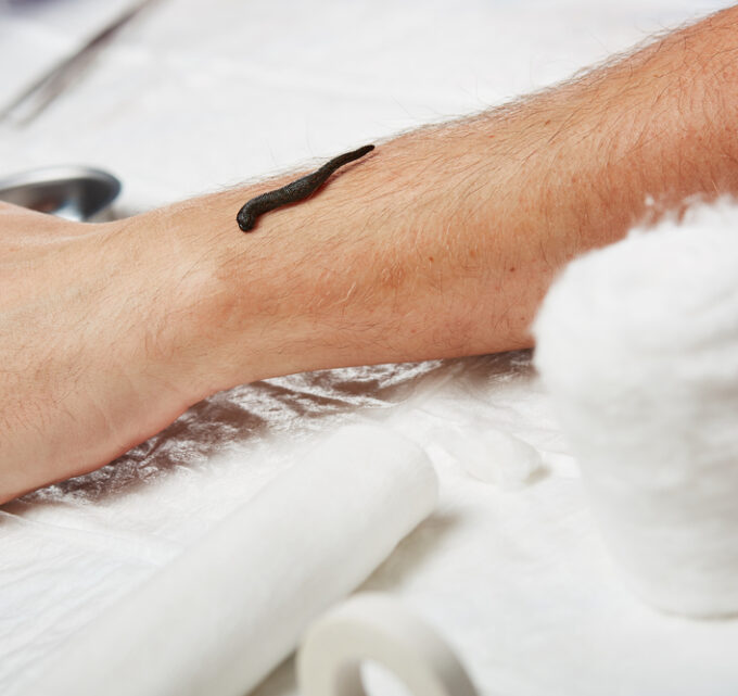 BioTrendy - Hirudoterapia - Tradycyjna terapia w nowoczesnym wydaniu