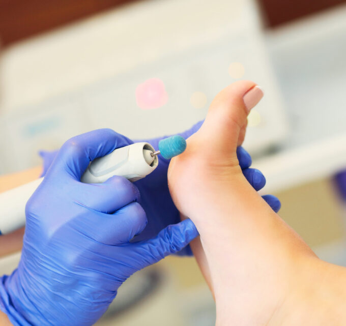 BioTrendy - Modzele na stopach – jak się ich pozbyć? Skuteczne preparaty i domowa pielęgnacja